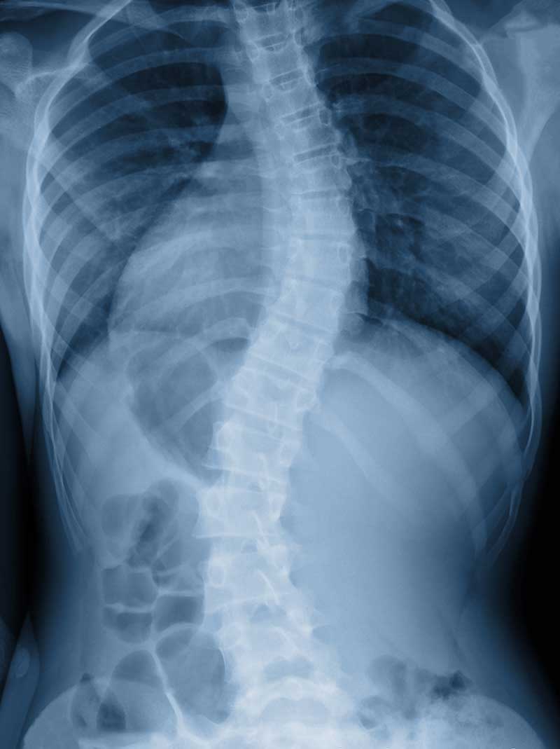 Scoliosis  Akron, OH 